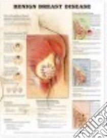 Benign Breast Disease Anatomical Chart libro in lingua di Anatomical Chart Company (COR)