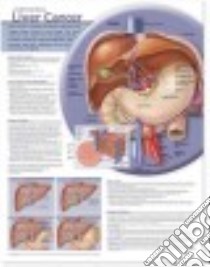 Understanding Liver Cancer Anatomical Chart libro in lingua di Anatomical Chart Company (COR)