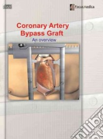 Coronary Artery Bypass Graft libro in lingua di Focus Medica Pte Ltd (COR)